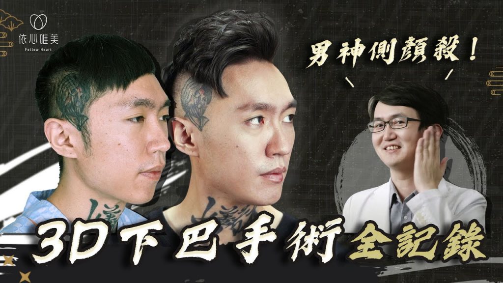 下巴後縮不夠帥?3D列印下巴手術!打造男神側顏殺|依心唯美 謝東穎醫師 @台中叁樓刺青