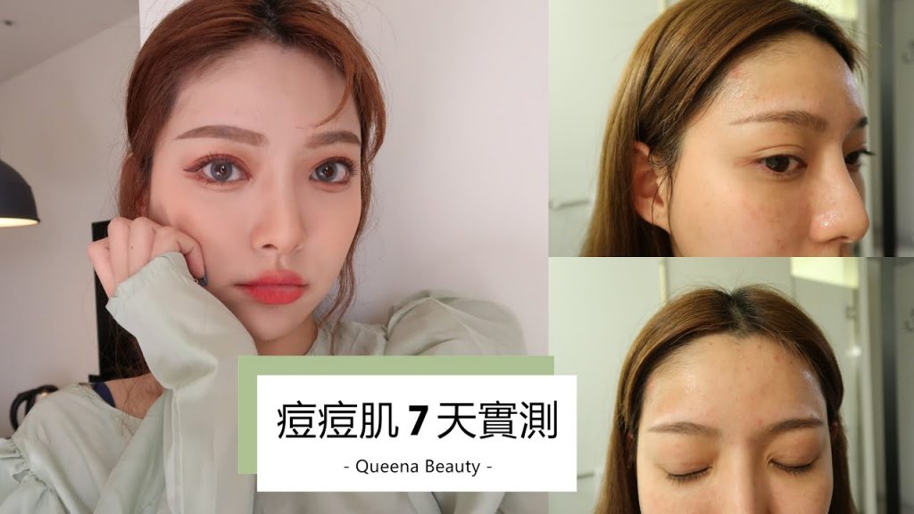 大家最愛問的痘痘肌怎麼處理!抗痘精華七天實測 | 安安兒Queena