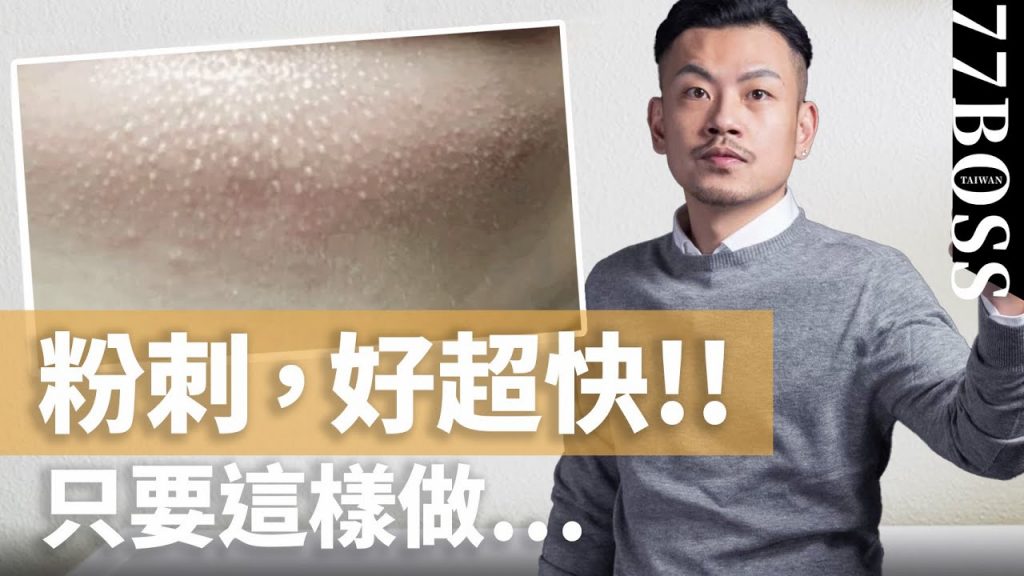 閉鎖粉刺要擠嗎?這樣做,粉刺好超快~~!! 【77老大】