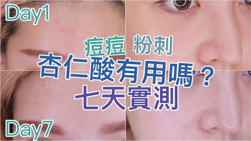 痘痘粉刺剋星杏仁酸有用嗎?偏油肌&敏感肌七天實測給你看!