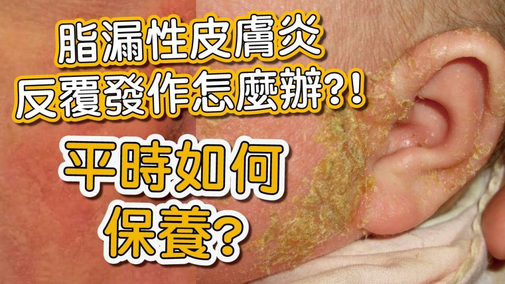 脂漏性皮膚炎好發在那些位置?一直反覆發作平時該如何保養?#shorts