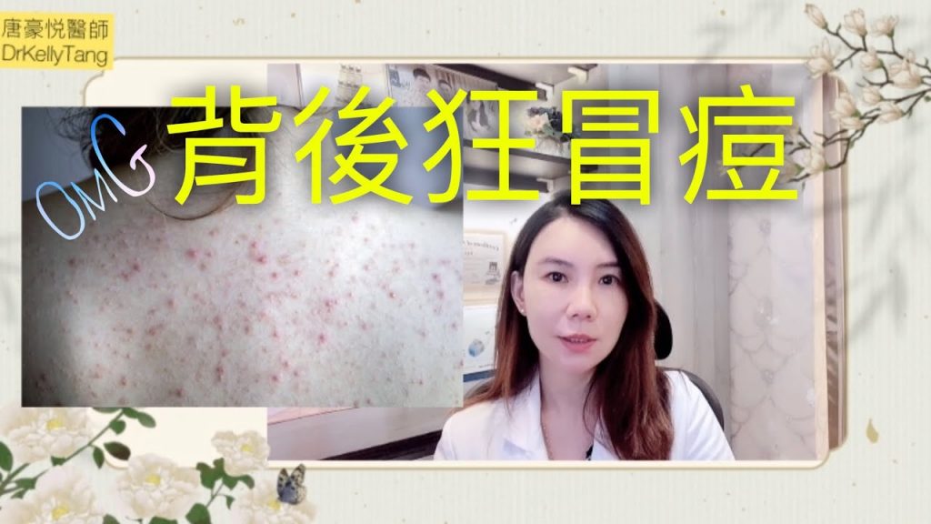 美背須知!胸口、背後長痘痘怎麼辦? 告別惱人的前胸後背長痘!預防 #毛囊炎 的生活小撇步及保養須知!(記得打開cc字幕喔)