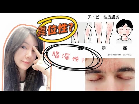 #濕疹 發作?#異位性皮膚炎 跟 #脂漏性皮膚炎 霧煞煞分不清楚⁉️ 一次搞懂常見濕疹還有注意事項,還原健康皮膚!(有cc字幕)