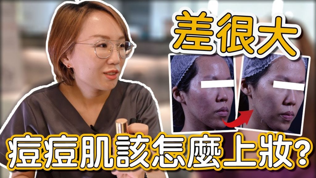 臉上長青春痘可以化妝嗎?化妝會不會讓青春痘惡化?莊醫師來告訴你!