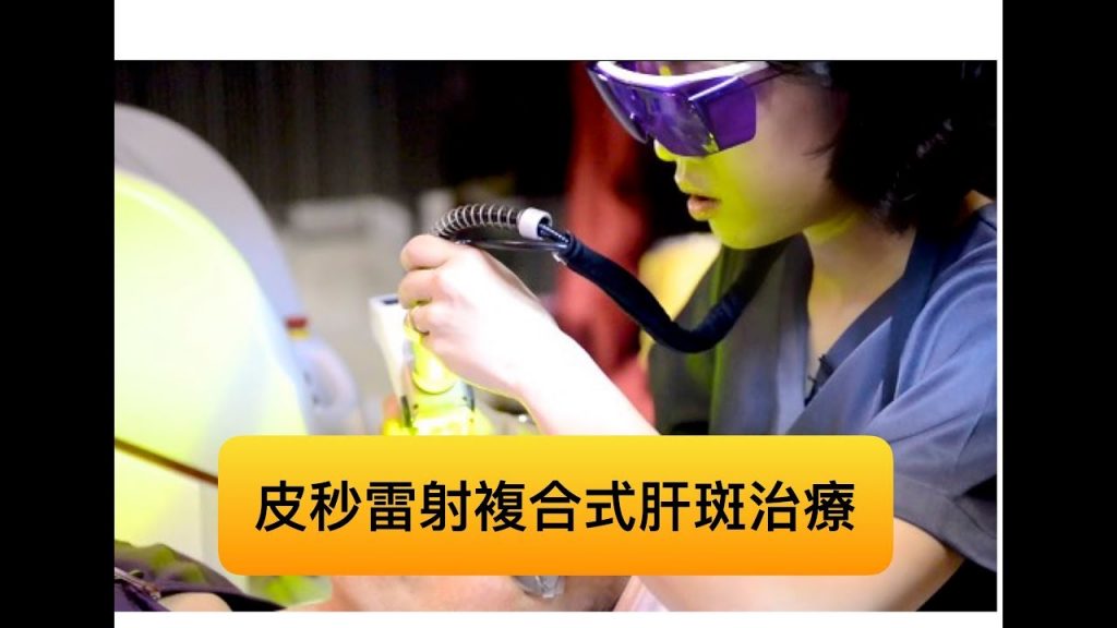 治療肝斑的新方法!皮秒雷射加585黃雷射的複合式療程!
