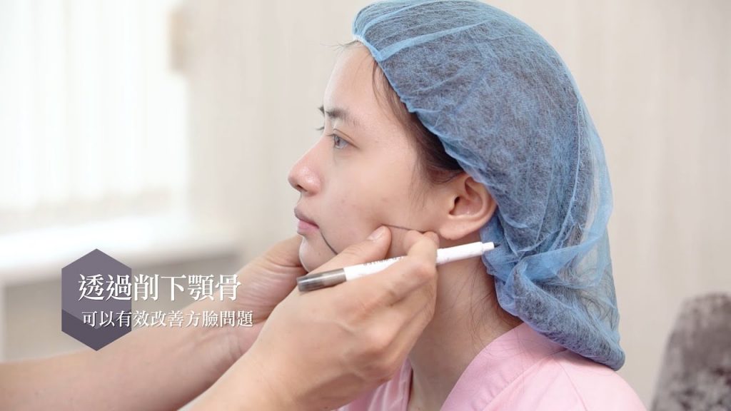下顎骨角削骨合併客製化墊下巴手術下臉結構調整解說Dr.郭菁松醫師