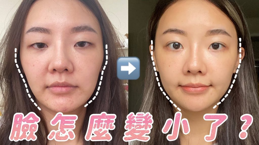 音波拉提三個月恢復全記錄|臉變小的秘密是😳肉毒抬頭紋?頰凹玻尿酸?|福爾思庭