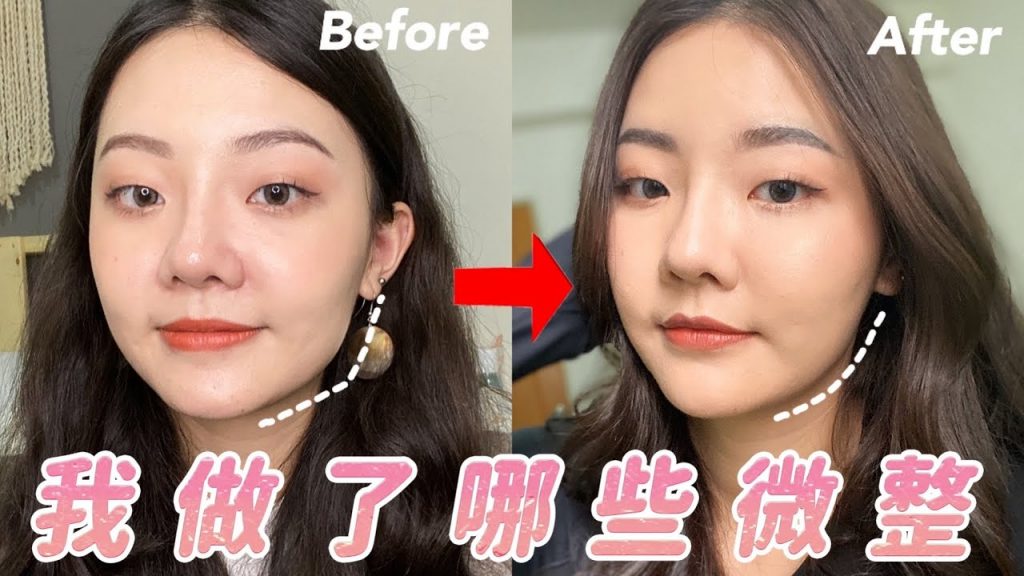 醫美微整|打了玻尿酸、肉毒、消脂針|福爾思庭