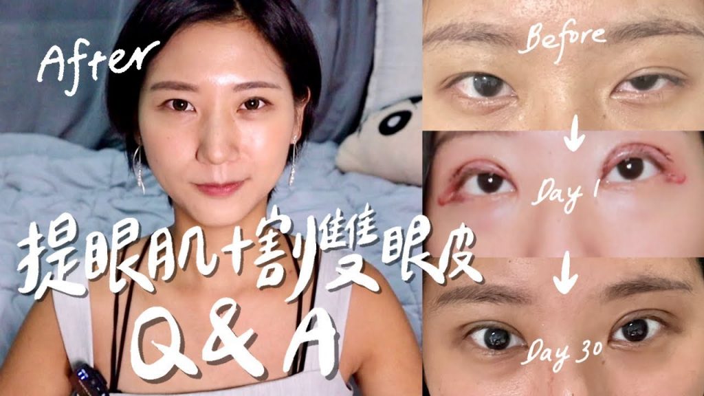 【提眼肌+割雙眼皮Q&A】手術總花費?診所醫生?批評聲音心理調適?恢復期6個月心路歷程!|大小眼 眼皮下垂 提眼肌無力|林宣 Xuan Lin
