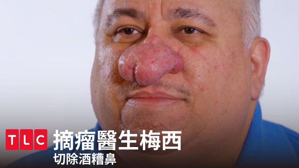 《摘瘤醫生梅西》切除酒槽鼻!拜拜令人尷尬的小丑大鼻子|TLC 旅遊生活頻道