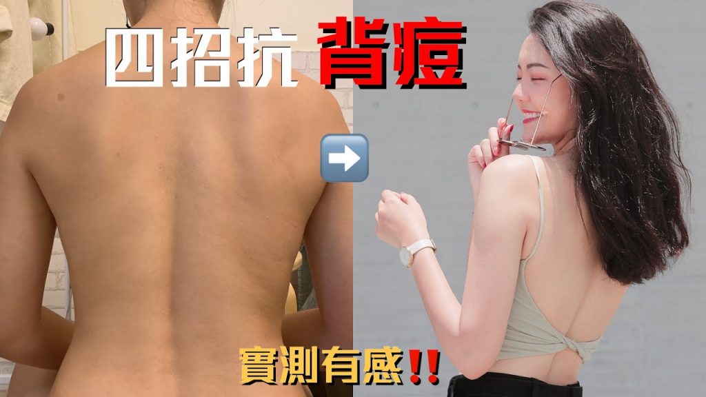 還我美背!四招背部抗痘心得|福爾思庭 ft. 寶拉珍選