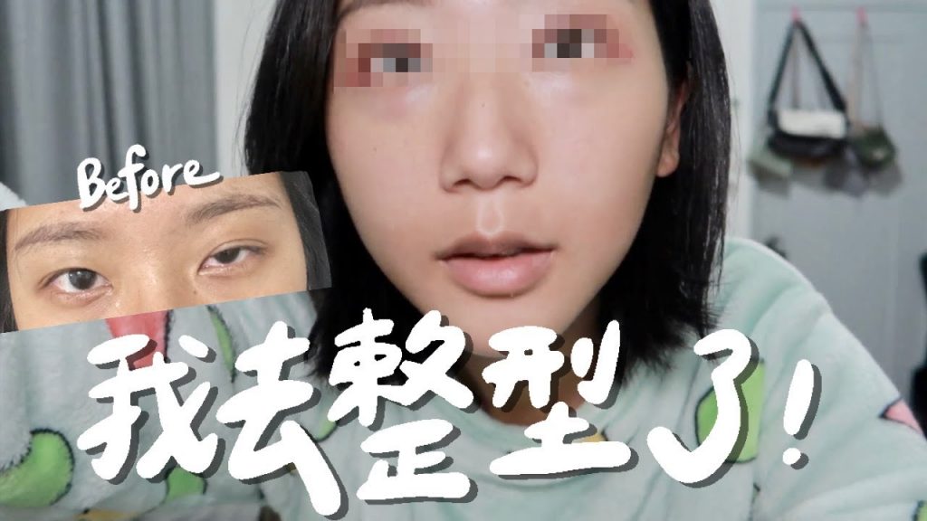 我是逼不得已的…割雙眼皮+提眼瞼肌手術,兩個月全記錄!|大小眼 眼皮下垂 提眼肌無力|林宣 Xuan Lin