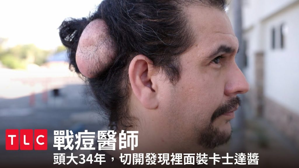 《戰痘醫師》頭大34年,切開裡面居然是…濃郁的卡士達醬?|TLC 旅遊生活頻道