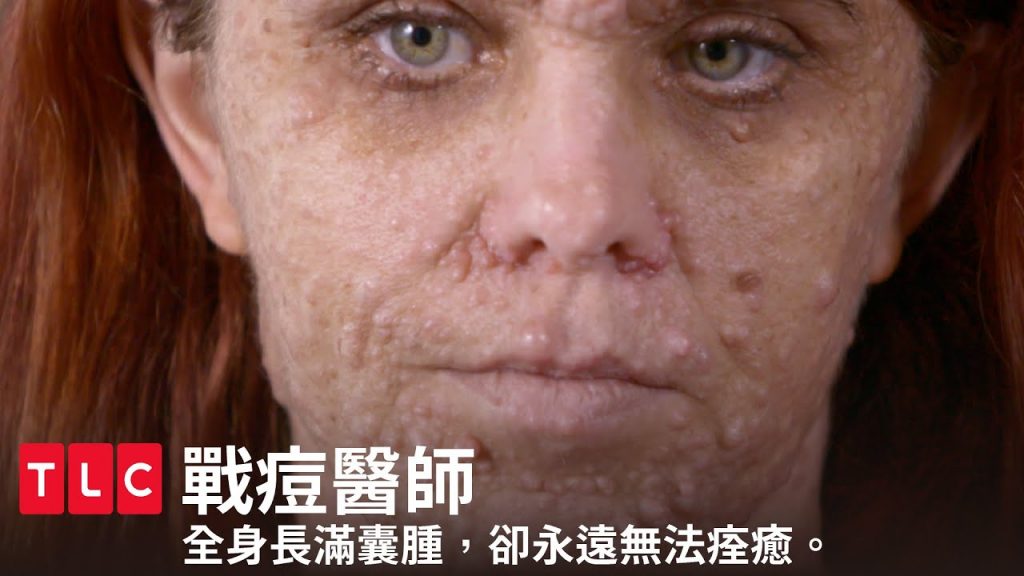 《戰痘醫師》全身長滿無法被根治的囊腫,難道此生注定沒有自信?|TLC 旅遊生活頻道