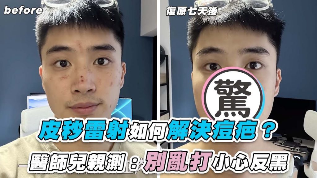 【皮秒雷射如何解決痘疤?醫師兒親測:別亂打小心反黑】|@凱文羊