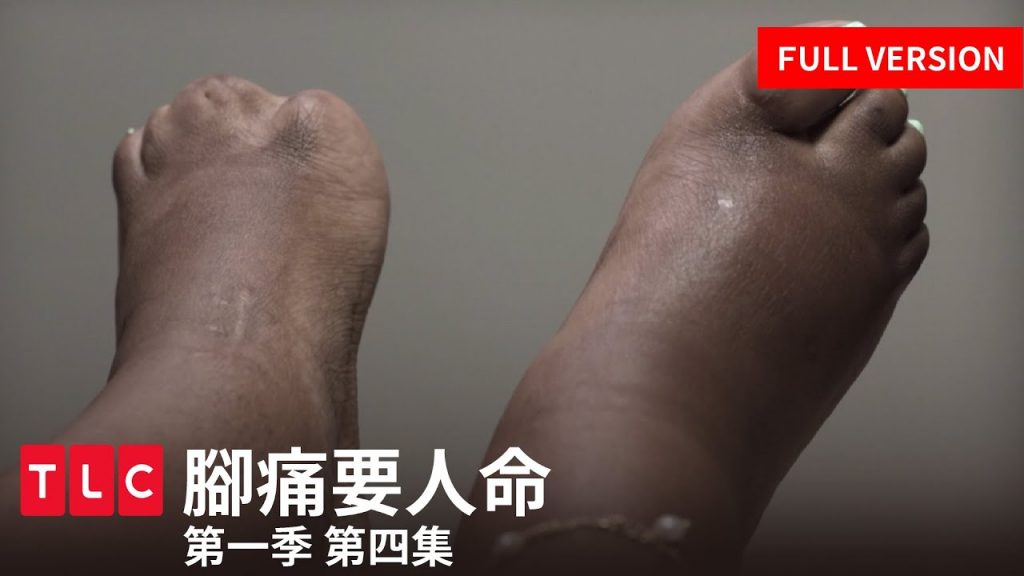 《腳痛要人命》完整版—腳趾長在腳裡面,指甲踩在腳下面|第一季 第四集|TLC 旅遊生活頻道