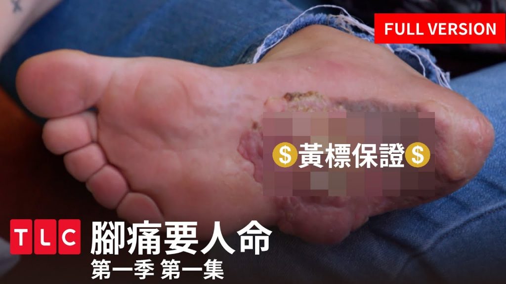 《腳痛要人命》完整版—畫面寫實,保證黃標,足科疾病治療大公開,請觀眾斟酌欣賞|第一季第一集|TLC 旅遊生活頻道