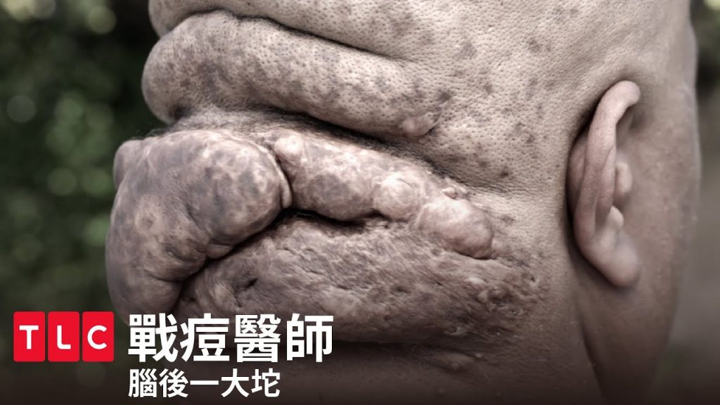 《戰痘醫師》腦後一大坨,史上最難纏的蟹足腫敵人!|TLC 旅遊生活頻道