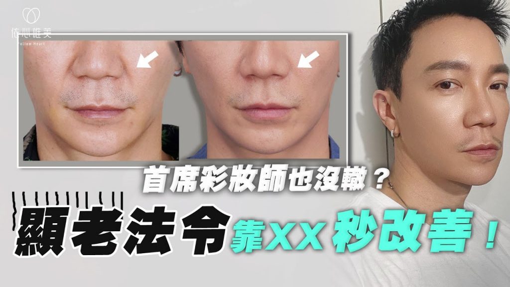 專業化妝師也煩惱的法令紋問題!靠玻尿酸來解決|依心唯美 林子宇醫師