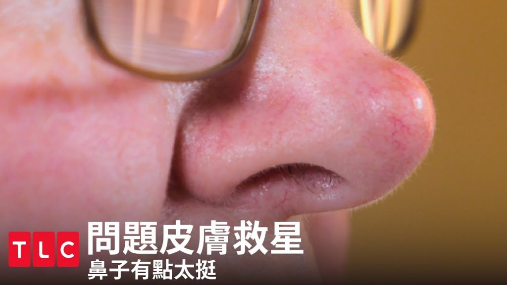 《問題皮膚救星》偽・墊鼻子。|TLC 旅遊生活頻道