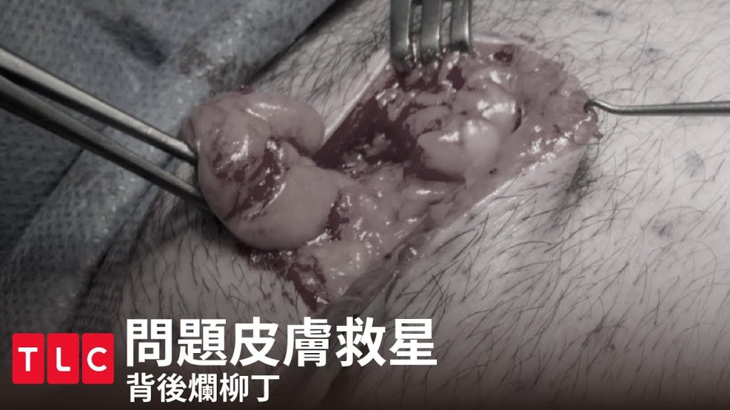 《問題皮膚救星》背後挖出爛柳丁|TLC 旅遊生活頻道