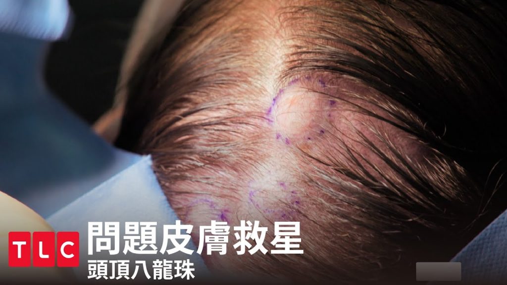 《問題皮膚救星》頭上有著八龍珠|TLC 旅遊生活頻道
