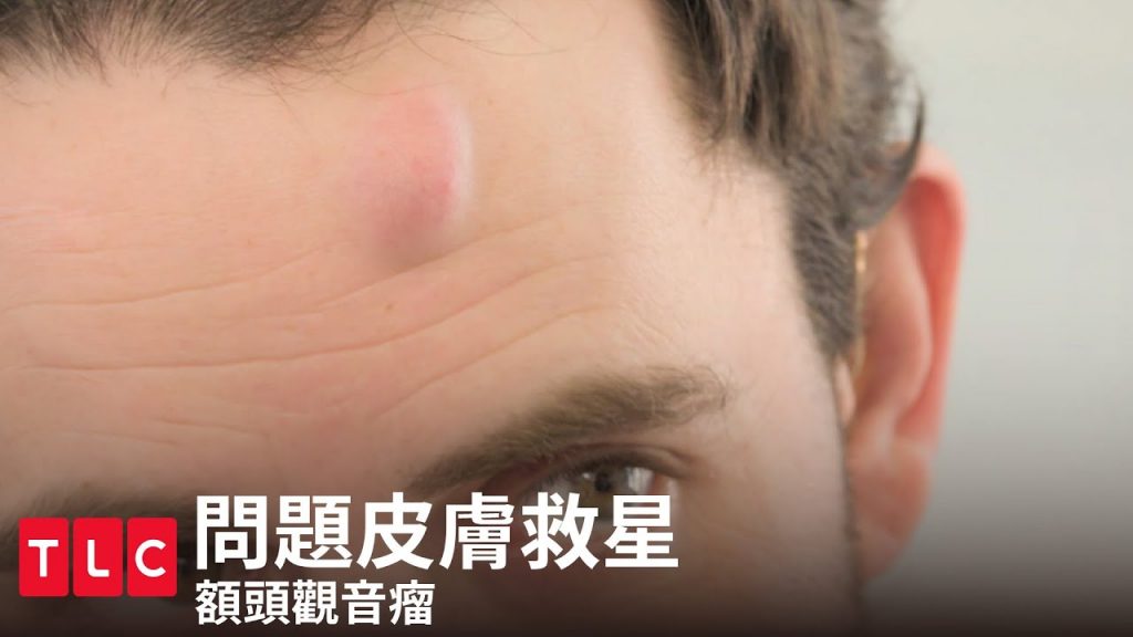 《問題皮膚救星》頭上一顆觀音瘤?10分鐘擠一顆!|TLC 旅遊生活頻道
