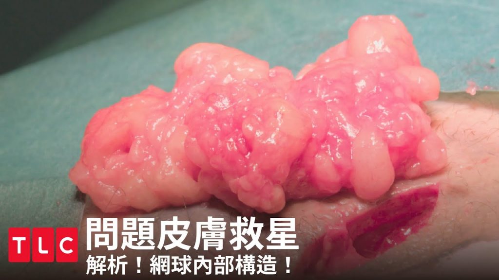 《問題皮膚救星》原來網球切開是長這個樣子!內含無碼全彩手術畫面,請觀眾斟酌欣賞|TLC 旅遊生活頻道