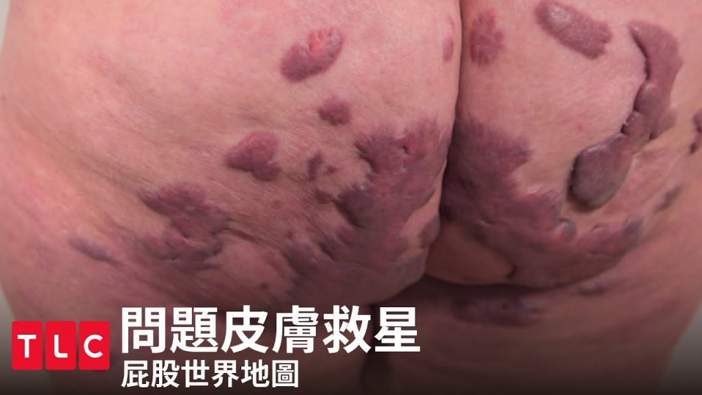 《問題皮膚救星》屁股世界地圖,內含無碼手術、屁股畫面,請觀眾斟酌欣賞|TLC 旅遊生活頻道