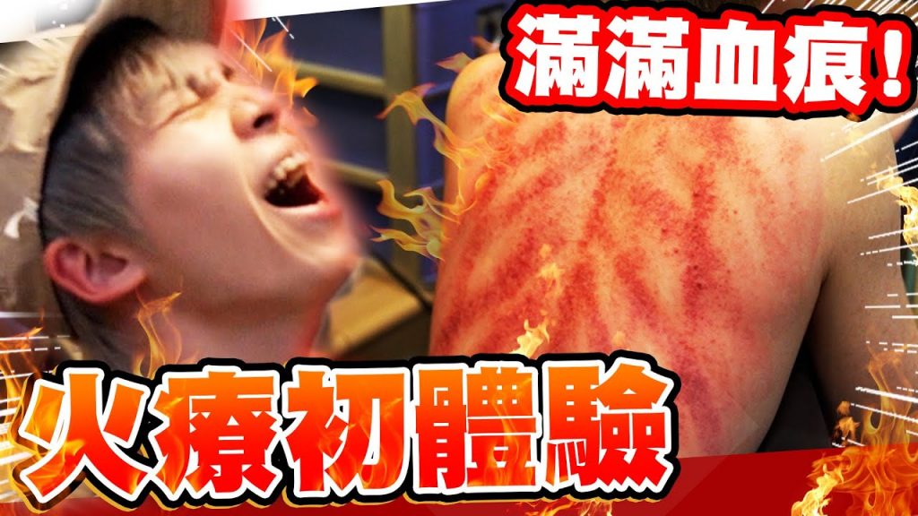 民俗療法「火療」火焰直接燒上身!背上滿滿血痕···【黃氏兄弟】