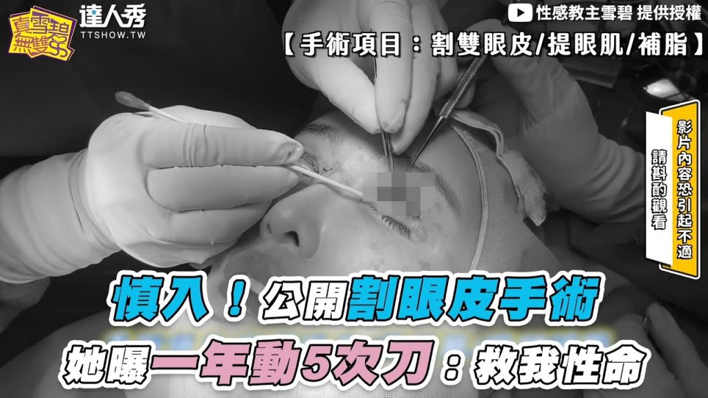 【慎入!公開割眼皮手術 她曝一年動5次刀:救我性命】@性感教主雪碧