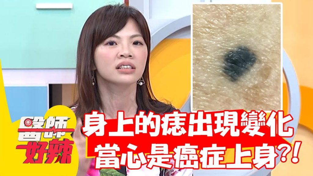 身上的「痣」出現變化,當心是癌症上身?!【#醫師好辣】20220407 part4 EP1310 陳榮堅 張振榕
