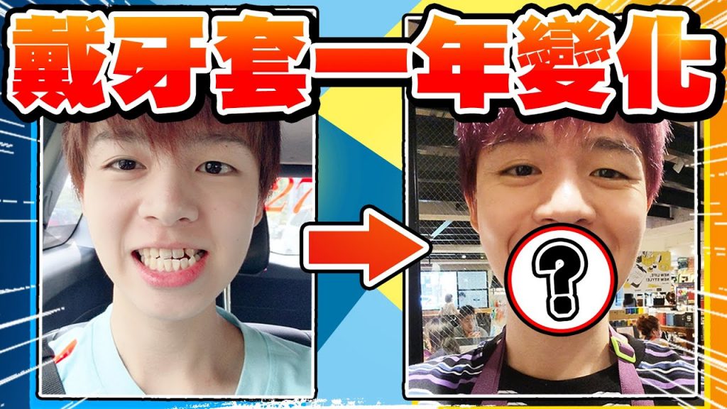 記錄戴牙套365天的照片,變化超驚人!卻要面對開刀⋯【黃氏兄弟】隱形牙套 矯正牙齒 隱適美