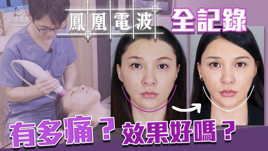 告別下垂嘴邊肉!鳳凰電波拉提術 全程記錄大公開|依心唯美 謝東穎醫師