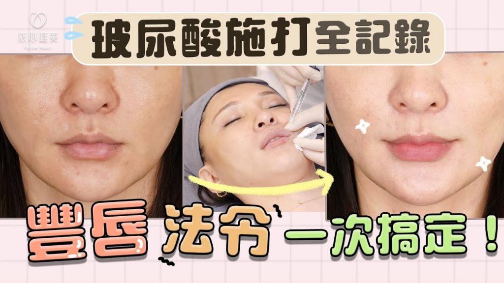 玻尿酸創造微笑唇!微整豐唇實錄 同時改善法令下巴 |依心唯美 謝東穎醫師