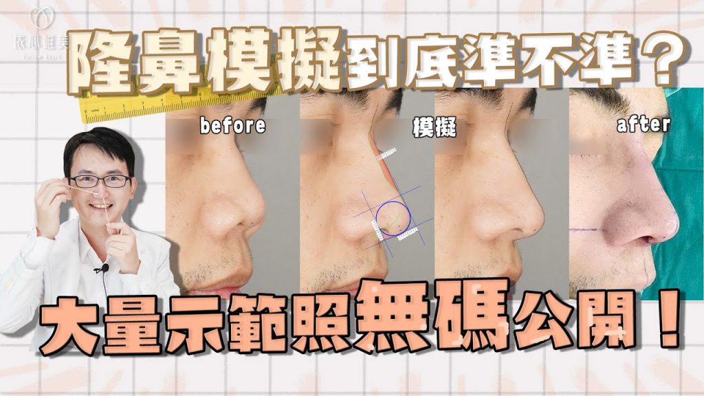 如何讓隆鼻更加滿意?術前模擬不可少!真實模擬對比公開|依心唯美 謝東穎醫師