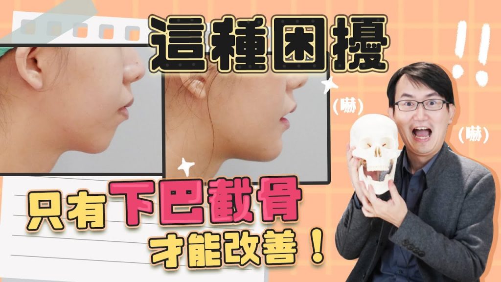 下巴截骨後遺症多?墊下巴無法改善的 下巴截骨竟完美解決!|依心唯美 謝東穎醫師
