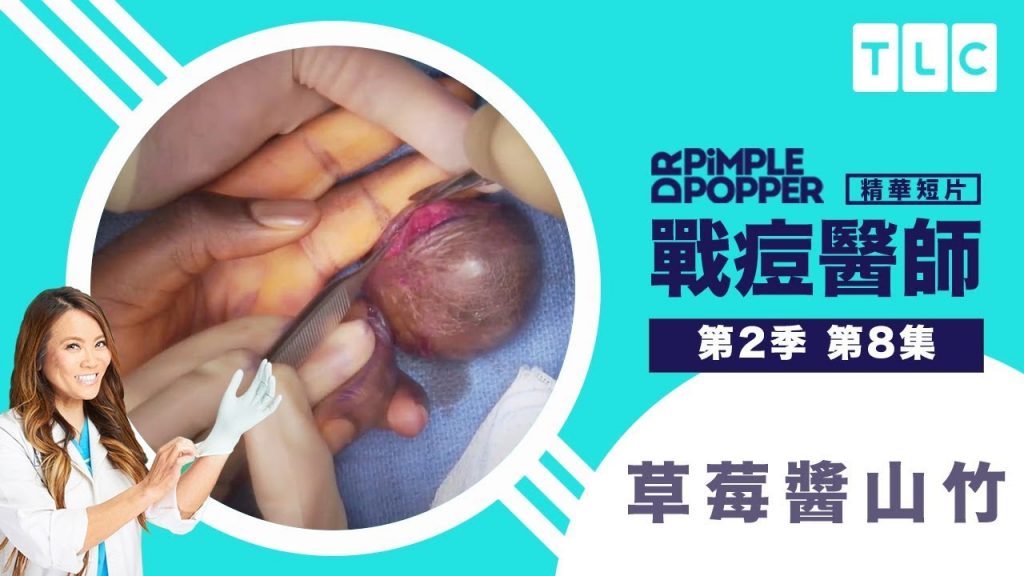 《戰痘醫師》100克拉鑽戒移除記!乍看之下真像加了草莓醬的山竹|TLC 旅遊生活頻道