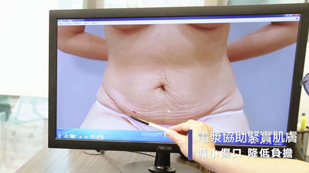 小腹部拉皮合併超能電漿縮皮手術,縮小疤痕也可達到腹部拉皮效果嗎 Dr 吳孟頴醫師