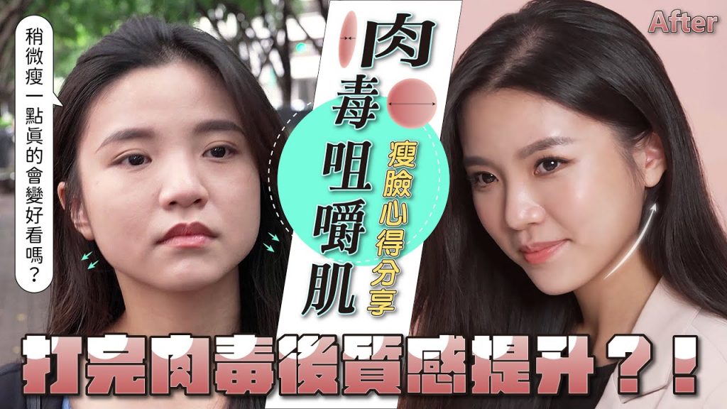 肉毒瘦臉心得分享,稍微瘦一點真的會變好看嗎?打完肉毒後質感真的提升了!