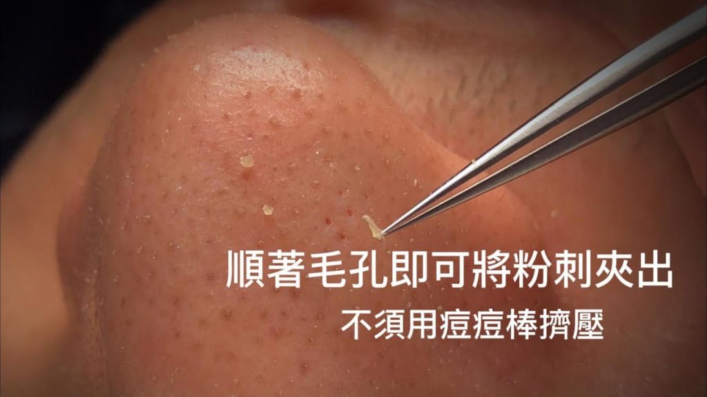 無痛清粉刺-順著毛孔即可將粉刺夾出