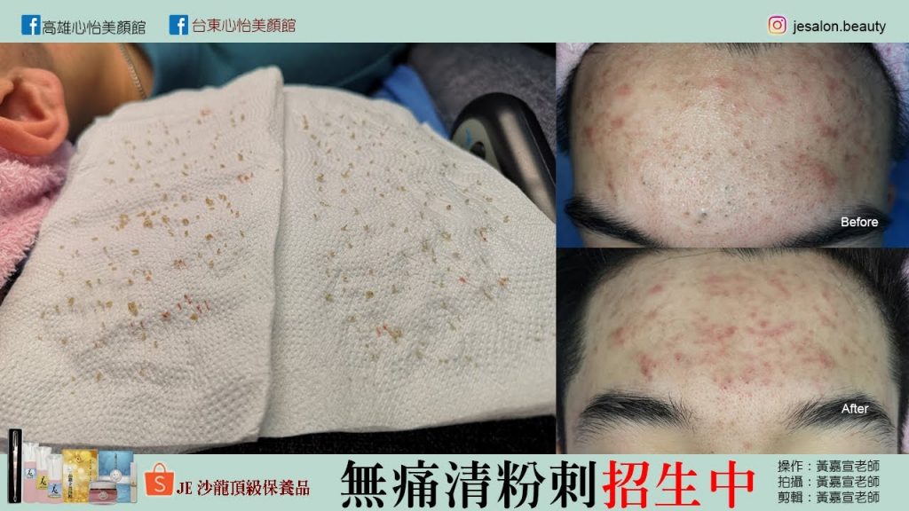 JE big acne額頭巨大粉刺-無痛技術-高雄心怡美顏館-高雄做臉首選-歡迎預約