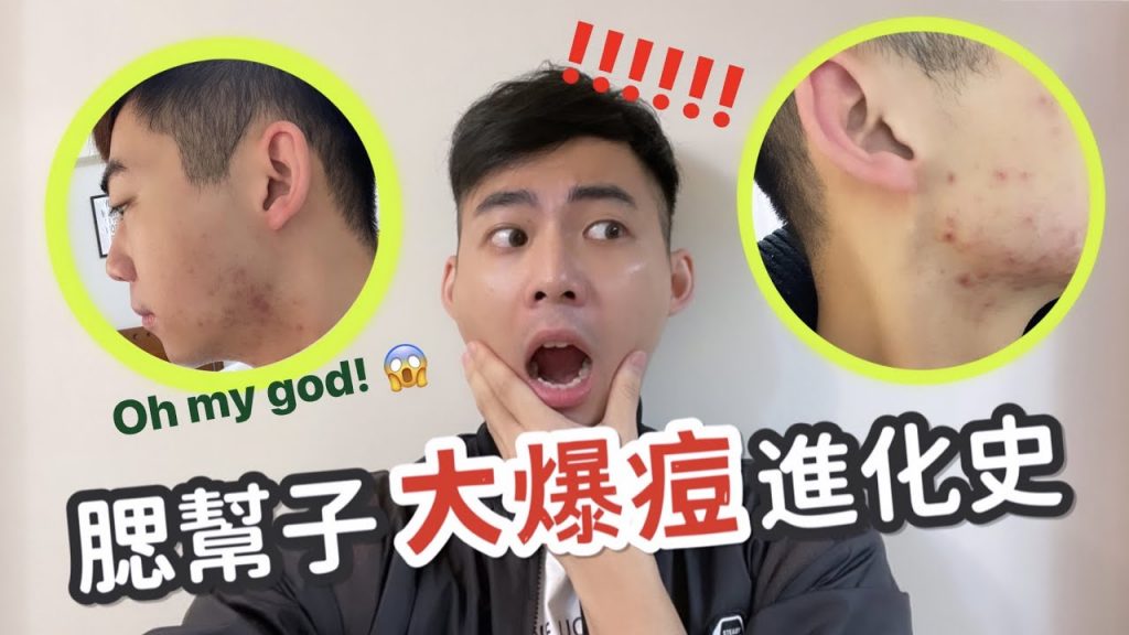 腮幫子「大爆痘」之超崩潰皮膚進化史|恐怖到不敢見人|如何找出皮膚痘痘問題? 😨 | Daniel Hsu 丹尼爾