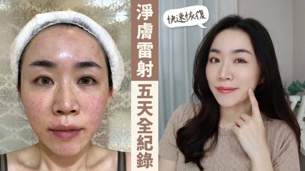 敏感肌的「淨膚雷射」術後5天全紀錄、怎麼保養、術前該準備什麼?