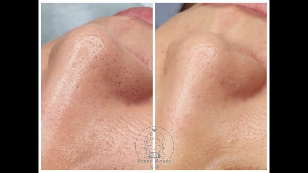 粉刺毛孔調理#台中做臉#粉刺痘痘#八合一雞尾酒療法#一中街#毛孔