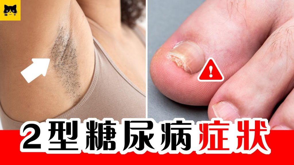 糖尿病| 11個2型糖尿病的症狀