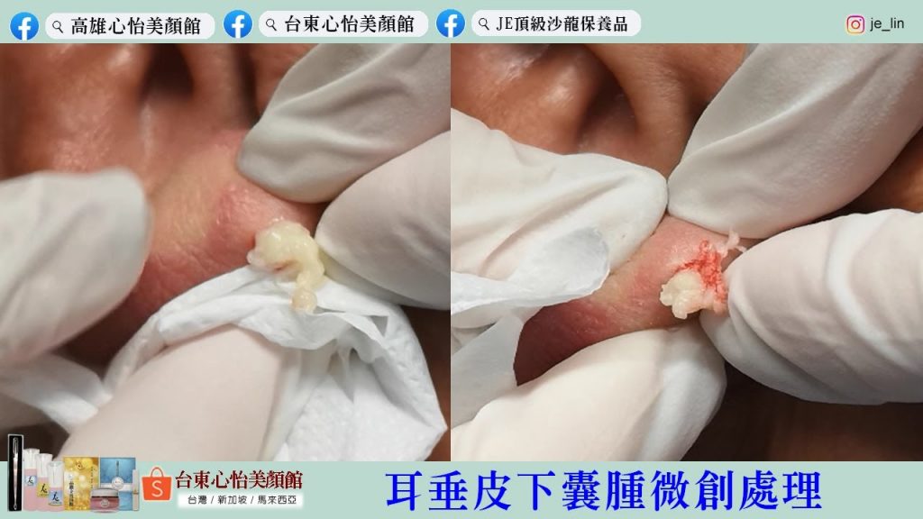JE耳垂皮膚囊腫無痛處理-心怡美顏館,台東店/高雄店-歡迎預約@lin232623
