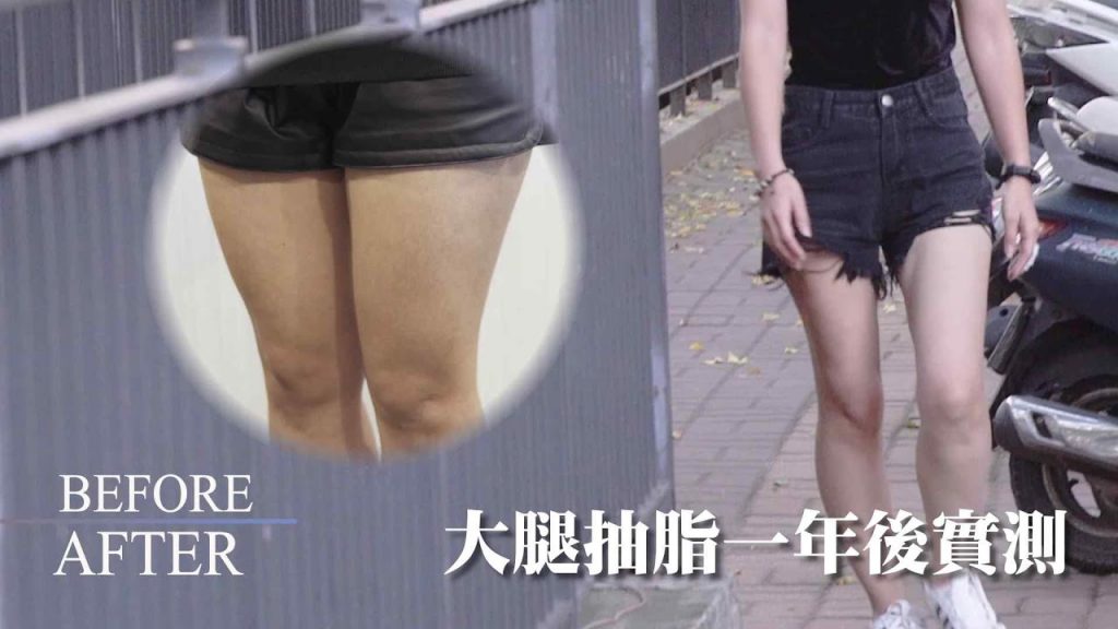 大腿抽脂手術後一年心得分享,大腿抽脂完後穿起短褲實測,勻稱修長腿型真驚人?!