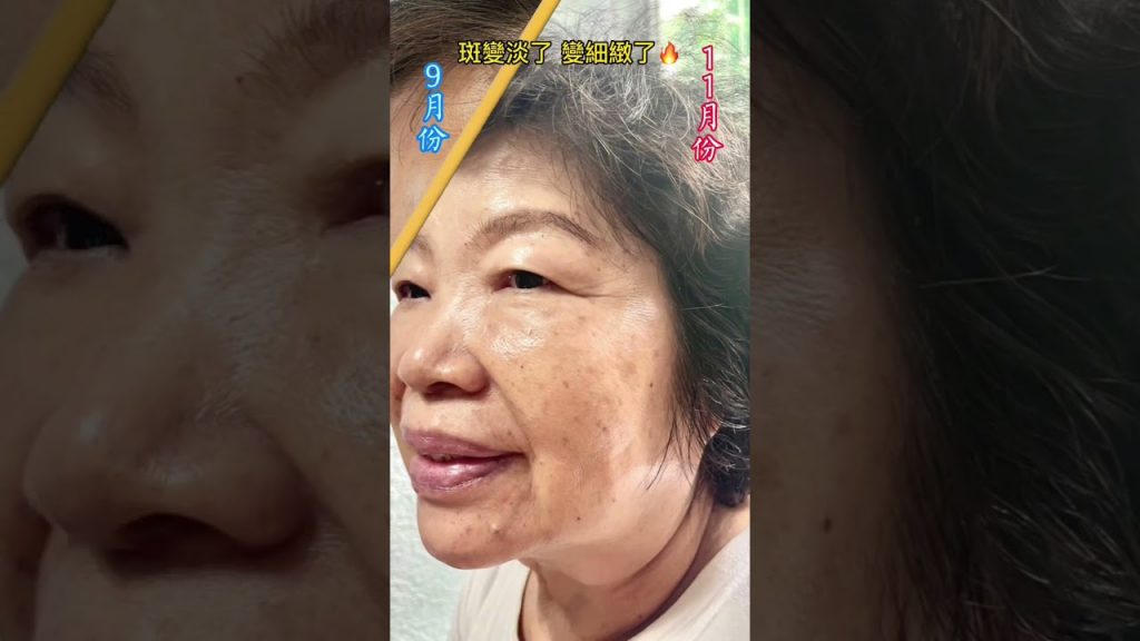 兩個月的改變🔥 #淨膚雷射#雷射#淡斑#皮秒雷射#保養品#護膚品#換一套保養品#shorts