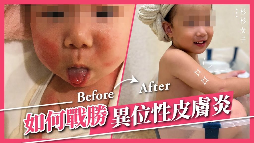 我用了這四個方法,治好我自己和孩子的中重度異位性皮膚炎,30年資深患者的真實分享(上) |杉杉女子